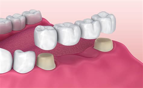 Dental Bridges.